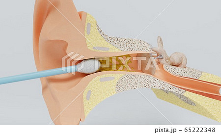 3d render ear cleansing earwax ear stick. 3d illustration 65222348