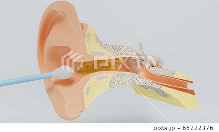 3d render ear cleansing earwax ear stick. 3d illustration 65222376