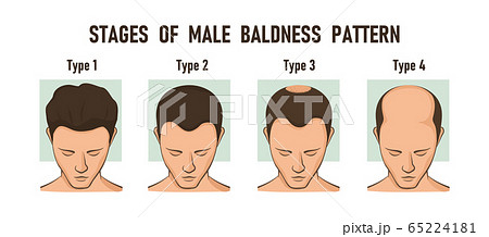 Stages of male baldness pattern. Male hair loss - Stock Illustration  [65224181] - PIXTA