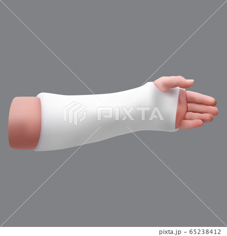Gypsized broken arm. Isolated realistic object. Vector 65238412