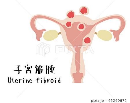 子宮筋腫のイラスト 子宮筋腫のイラスト 65240672