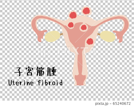 子宮筋腫のイラスト 子宮筋腫のイラスト 65240672