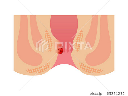 痔のタイプ・種類 (肛門断面図イラスト) / 内痔核  65251232