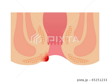 痔のタイプ 種類 肛門断面図イラスト 外痔核のイラスト素材