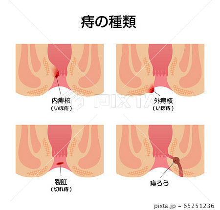 痔のタイプ 種類 肛門断面図イラスト のイラスト素材