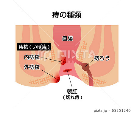 痔のタイプ 種類 肛門断面図イラスト のイラスト素材