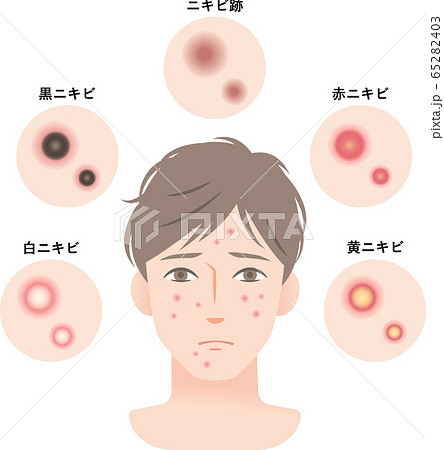 ニキビの種類 男性のイラスト素材