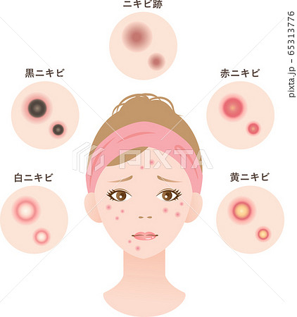 ニキビ 女性 美容 ニキビ 女性 美容 65313776