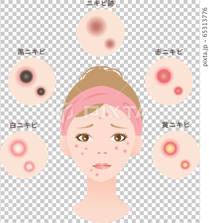 ニキビ 女性 美容 ニキビ 女性 美容 65313776