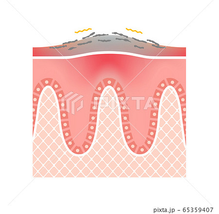 乾癬の肌 断面図イラスト 文字なし のイラスト素材