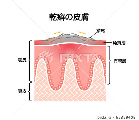 乾癬の肌　断面図イラスト  65359408