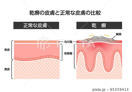乾癬と健康な肌の比較 断面図イラスト 乾癬と健康な肌の比較 断面図イラスト 65359413