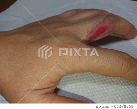 やけど 65378559