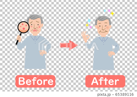Grandpa's Before After with a breakout on his face Grandpa's Before After with a breakout on his face 65389116