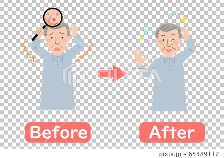 Grandpa's before-after after being concerned about scalp breakouts Grandpa's before-after after being concerned about scalp breakouts 65389117