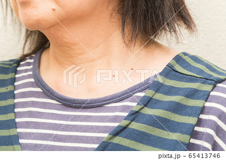 老人性イボ 首イボ 老人性イボ 首イボ 65413746
