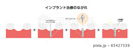インプラント治療のながれ　断面図イラスト  65427339