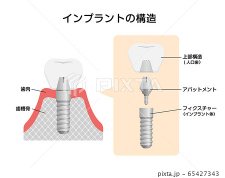 インプラントの仕組み 構造 断面図イラスト のイラスト素材 インプラントの仕組み 構造 断面図イラスト のイラスト素材