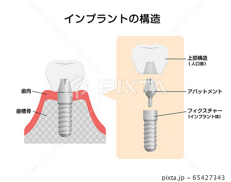 インプラントの仕組み・構造　断面図イラスト  65427343