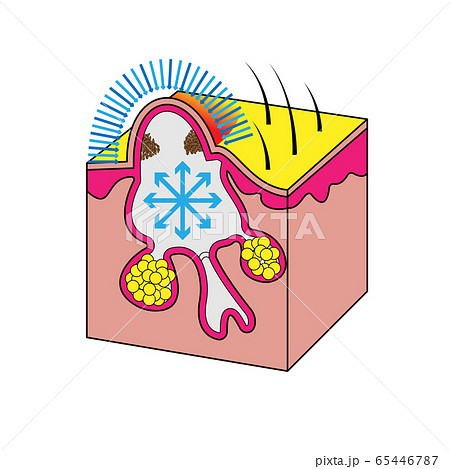 Formation of acne papule and pimples, vector Formation of acne papule and pimples, vector 65446787