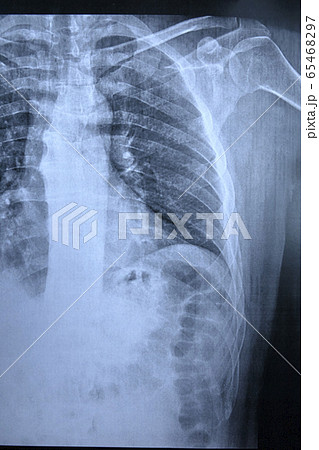 x-ray of lungs of a sick person x-ray of lungs of a sick person 65468297