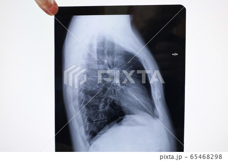 x-ray of lungs of a sick person x-ray of lungs of a sick person 65468298