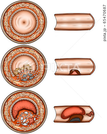 血管動脈硬化イラストのイラスト素材