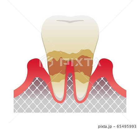 歯肉炎・歯周病のステージと症状イラスト / 中度の歯周炎 65495993