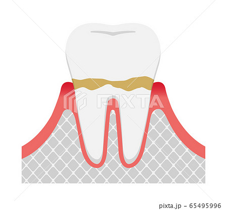 歯肉炎 歯周病のステージと症状イラスト 歯肉炎のイラスト素材