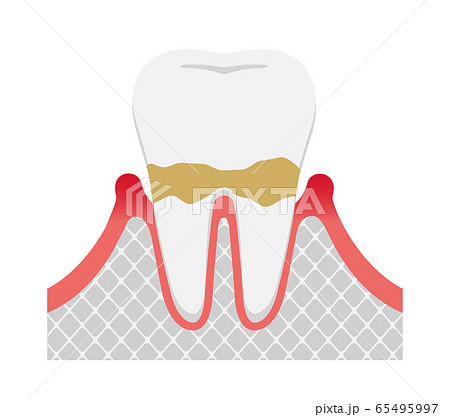 歯肉炎 歯周病のステージと症状イラスト 軽度の歯周炎のイラスト素材