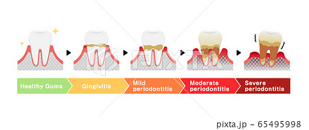 歯肉炎・歯周病のステージと症状イラスト(英語） 65495998