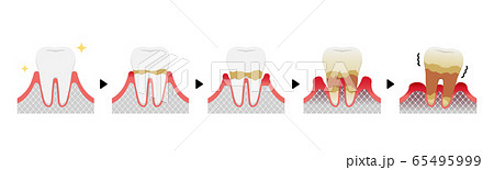 歯肉炎 歯周病のステージと症状イラスト 文字なし のイラスト素材