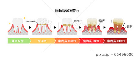 歯肉炎・歯周病のステージと症状イラスト 65496000