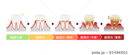 歯肉炎 歯周病のステージと症状イラストのイラスト素材