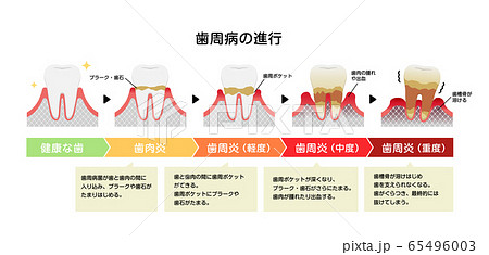 歯肉炎・歯周病のステージと症状イラスト 65496003