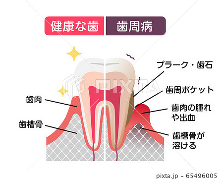 健康な歯と歯周病の歯の比較イラストのイラスト素材