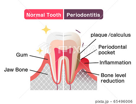 健康な歯と歯周病の歯の比較イラスト (英語) 65496006