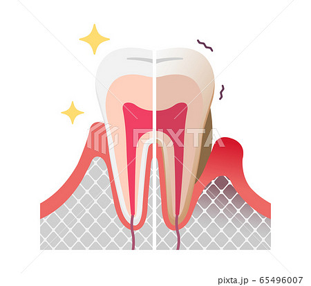 健康な歯と歯周病の歯の比較イラスト 文字なし のイラスト素材
