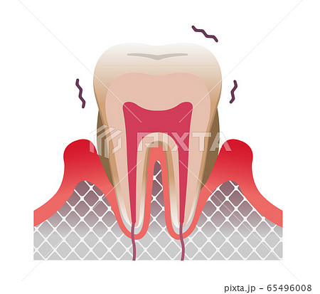歯周病の歯の断面図イラスト (文字なし) 65496008