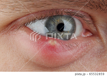 Close up abscess in the eye. hordeolum. stybarley on the eye. inflammation. stye Close up abscess in the eye. hordeolum. stybarley on the eye. inflammation. stye 65532859
