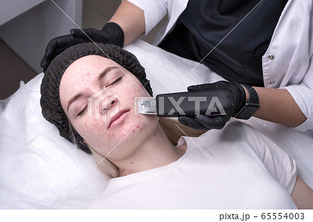 Ultrasonic face peel 65554003