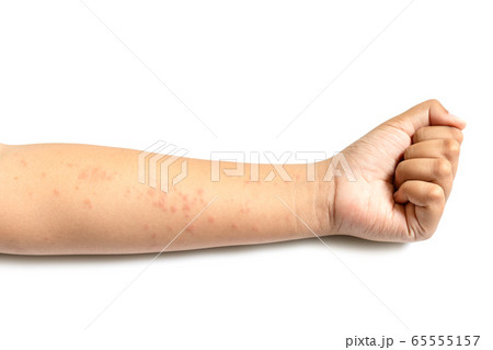 People getting red rash on the arm skin isolated 65555157