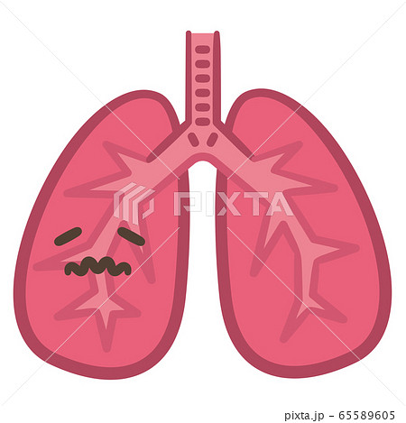 肺 病気 炎症のイラスト素材