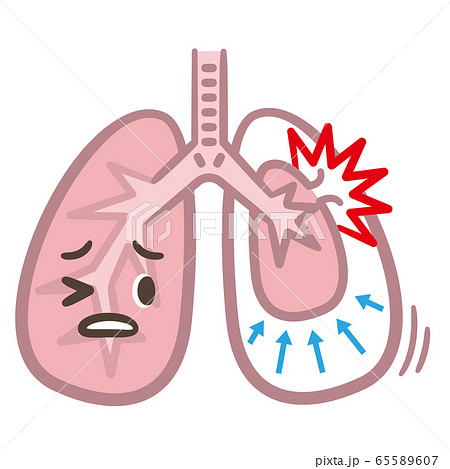 肺気胸 病気のイラスト素材
