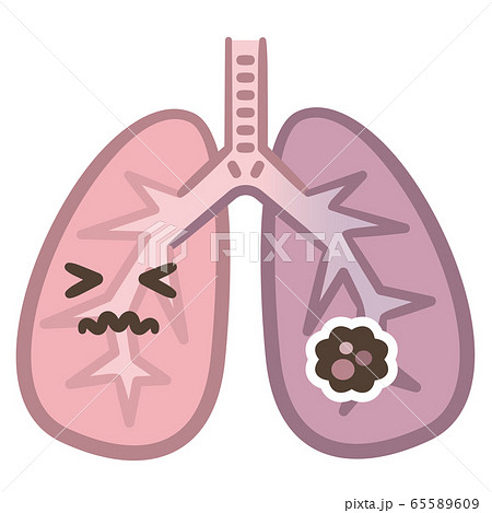 肺癌　誤嚥 65589609