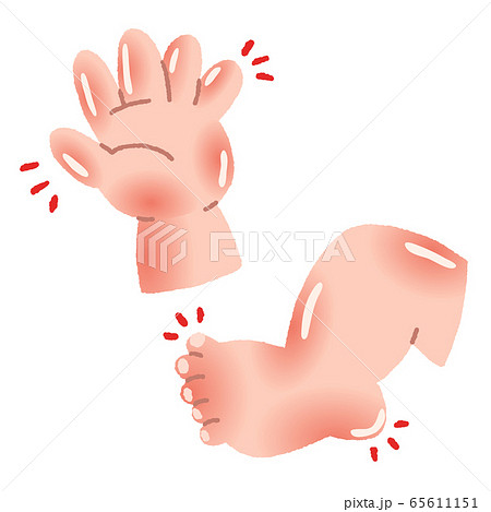 赤ちゃん 手足の腫れ 川崎病のイラスト素材
