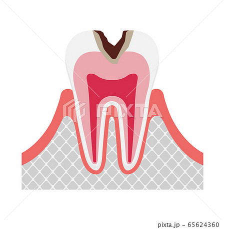 虫歯の進行と症状 イラスト / C2・中度の虫歯のイラスト素材 [65624360 