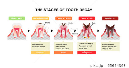 虫歯の進行と症状 イラスト 英語 解説文付き のイラスト素材