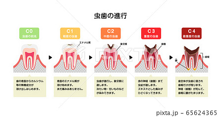 虫歯の進行と症状　イラスト (解説文付き） 65624365