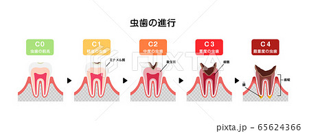 虫歯の進行と症状 イラスト のイラスト素材